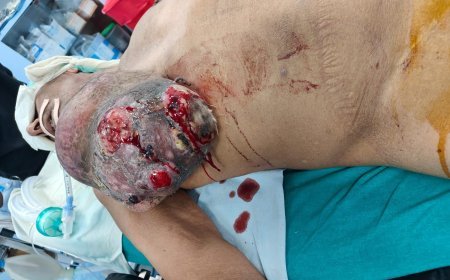 कोटा: सीने में 15 साल से बढ़ रहा 3 किलो का ट्यूमर निकाला, लकवाग्रस्त मरीज की बची जान