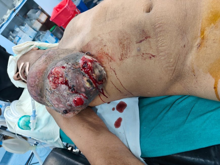 कोटा: सीने में 15 साल से बढ़ रहा 3 किलो का ट्यूमर निकाला, लकवाग्रस्त मरीज की बची जान